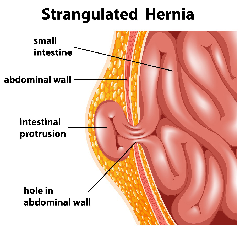 Hernia – Mallanets Tech Textile