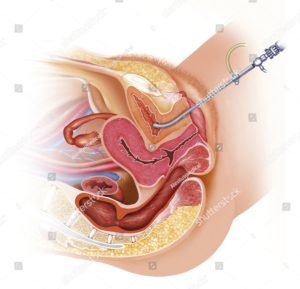 -cystoscopy-136154144