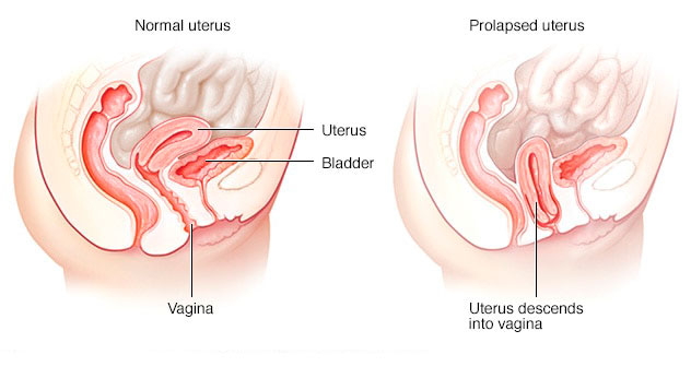 prolapso-uterino-mallanets-tech-textile